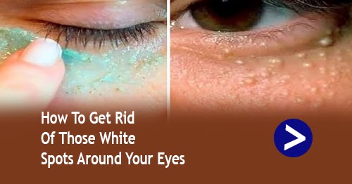 How To Get Rid Of Those White Spots Around Your Eyes Health Inspire