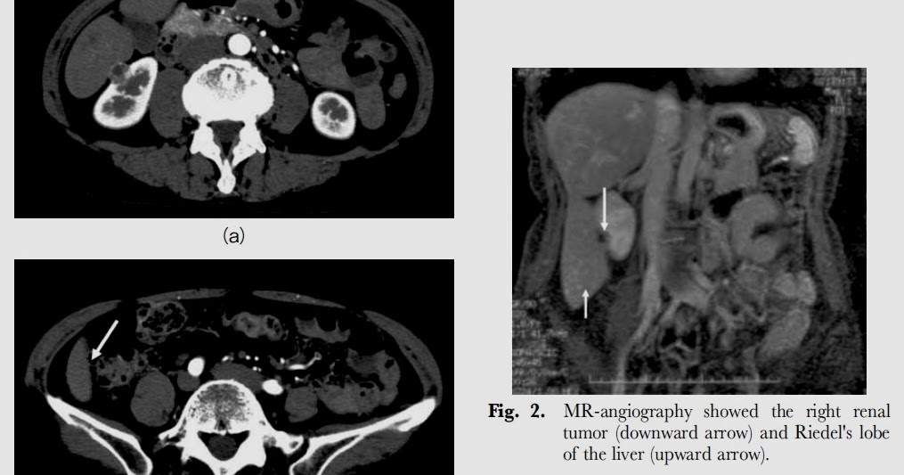 松下 ER ランチ・カンファレンス リーデル葉 Riedel's lobe