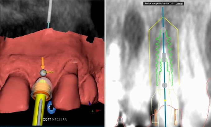 INTRAORAL SCAN for implant planning - Dr. Scott MacLean