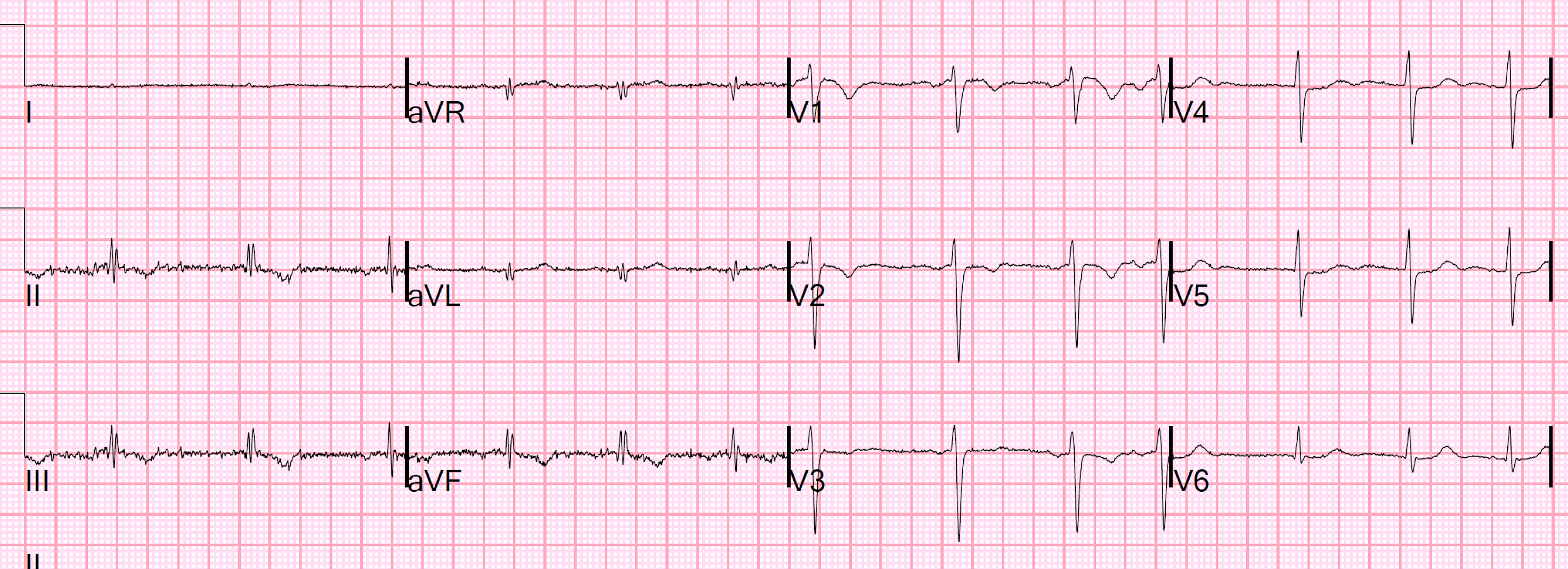 Dr. Smith's ECG Blog Atrial Fibrillation w Rapid Ventricular Response
