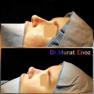 Micromotor Assisted Revision Nose Job, Micro-Motor Assisted Revision Rhinoplasty Operation,Revision Nose Aesthetic Operation in Turkey,