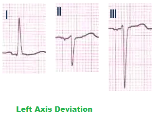 left-axis-deviation