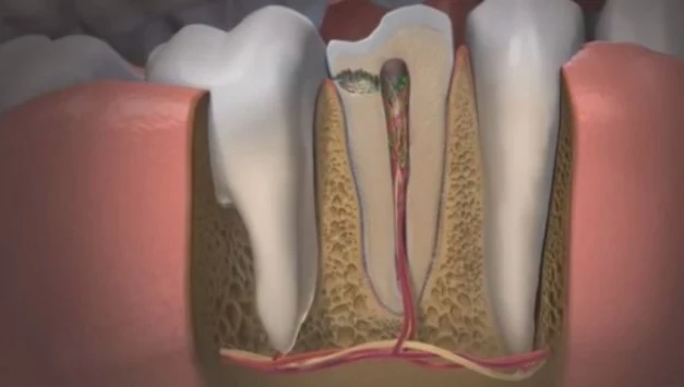 Μοναδικό βίντεο: Πώς δημιουργούνται οι τρύπες στα δόντια και τι να κάνετε!