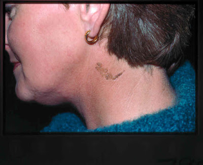 Dermpath Made Simple - Neoplastic: Benign Pigmented Lesions - Solar ...