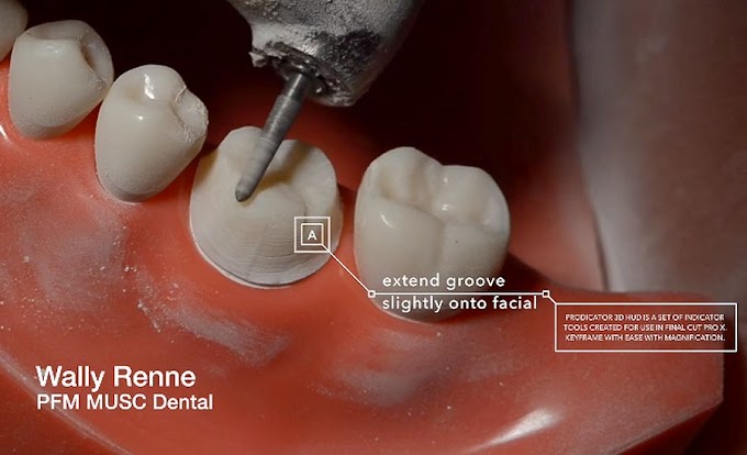 PFM CROWN: Preparation step by step