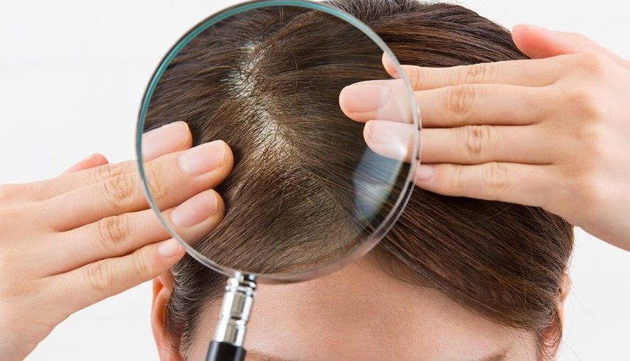 9 Cara Menghilangkan Kutu Rambut Dengan Cepat Dan Mudah Wajib di Bacain