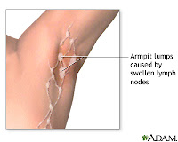 Armpit Lump / Remedies for Armpit Lumps