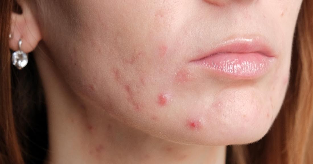 Pregnancy Acne and Natural Options for Treatment