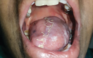 Microvascular free flap transfer helps cancer patient regain use of surgically removed tongue Microvascular free flap transfer helps cancer patient regain use of surgically removed tongue