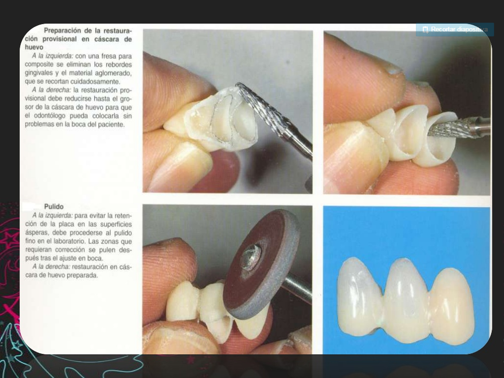 Provisionales dentales