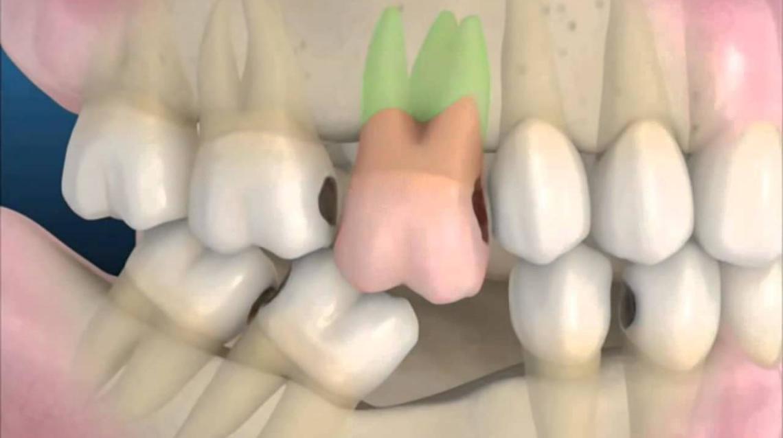 What Happens If Missing Teeth Are Not Replaced? Dr. Bharat Katarmal