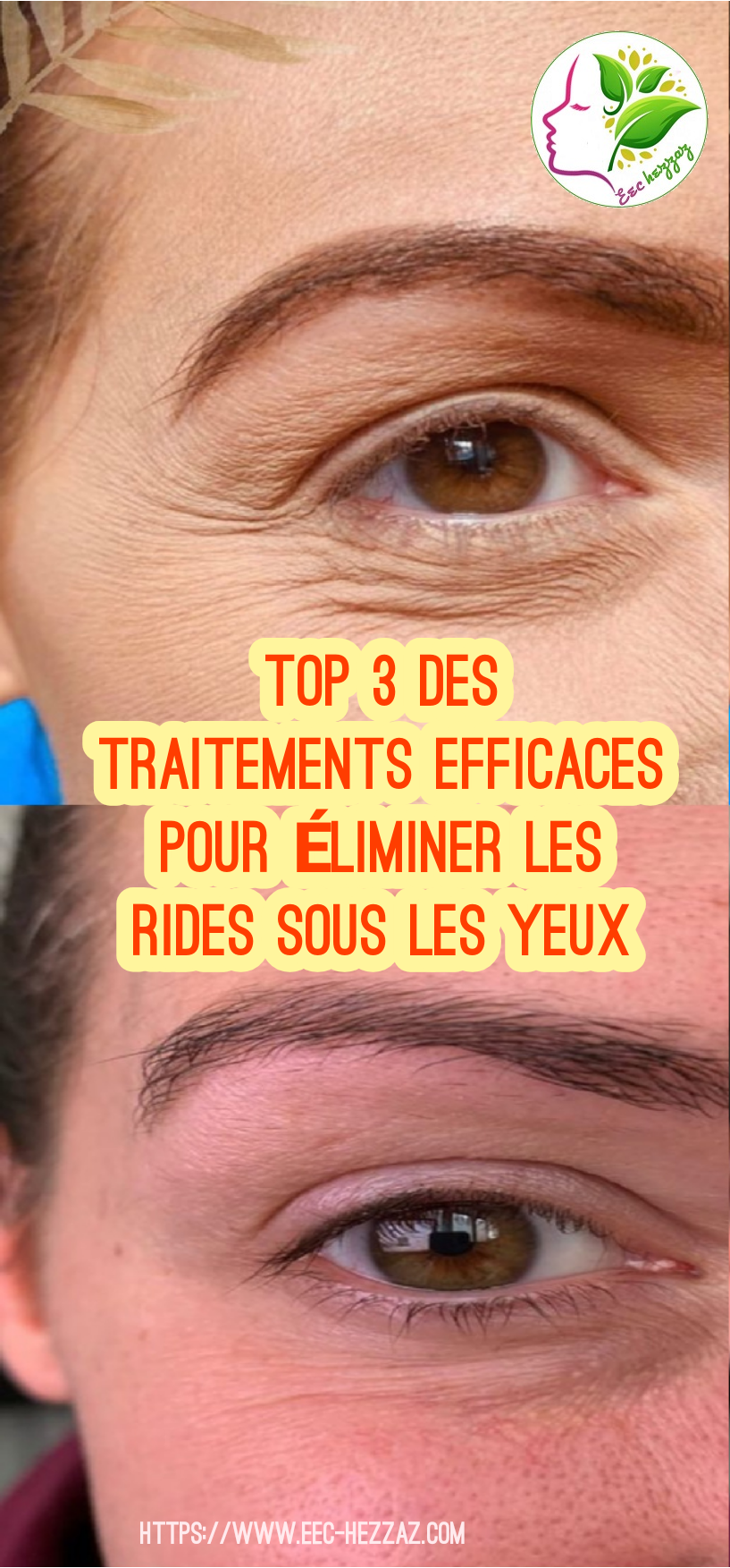 Top 3 des traitements efficaces pour éliminer les rides sous les yeux