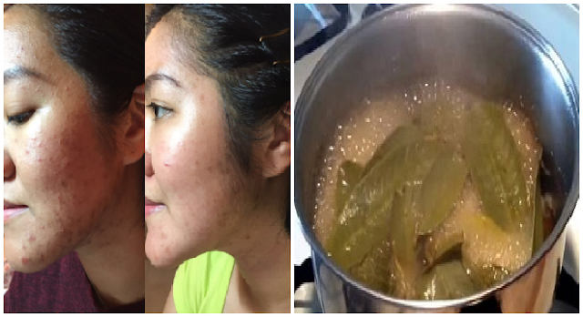 Tak Pėrlu Obat Crėam Mahal, Cukup Gunakan Daun Jambu Biji Untuk Mėnghilangkan Jėrawat, Kėriput dan Flėk Hitam di Wajah