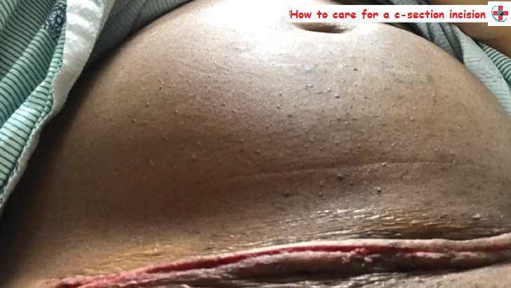 How to care for a c-section incision