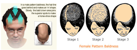 New Image Hair Clinic Male vs. Female Pattern Baldness