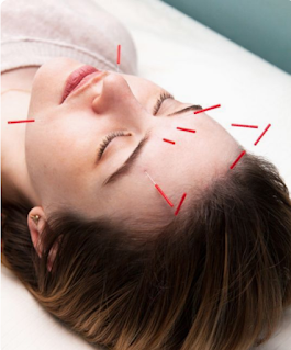 El lifting facial con acupuntura reafirma la piel, rellena las arrugas, aporta más brillo al rosto y favorece la producción de colágeno y elastina.