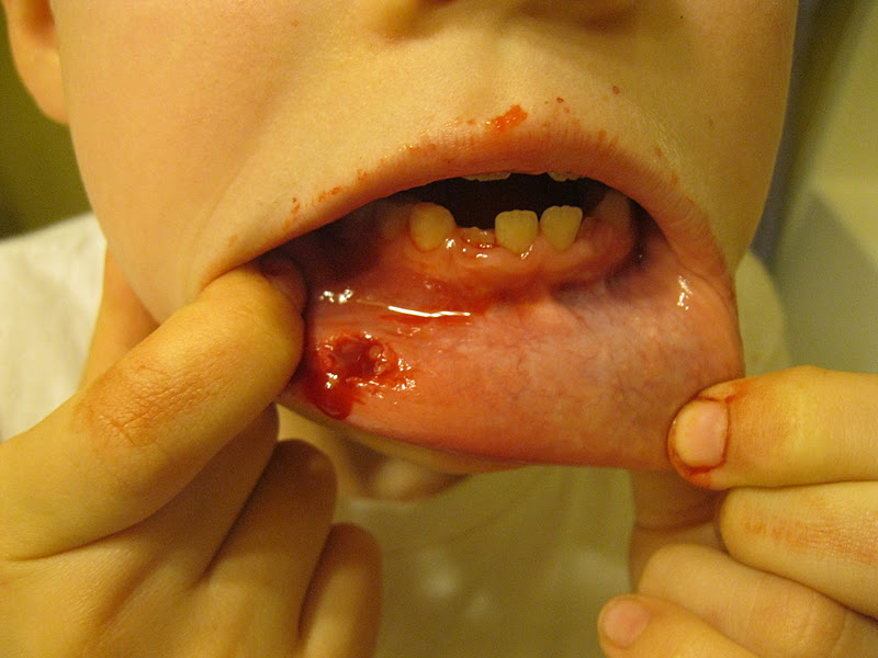 Heal Cut In Mouth 89