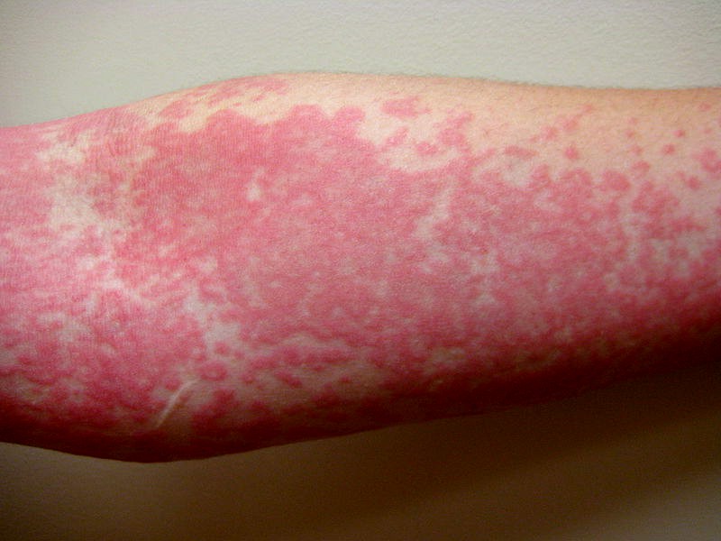 Chronic hives (urticaria) - Mayo Clinic