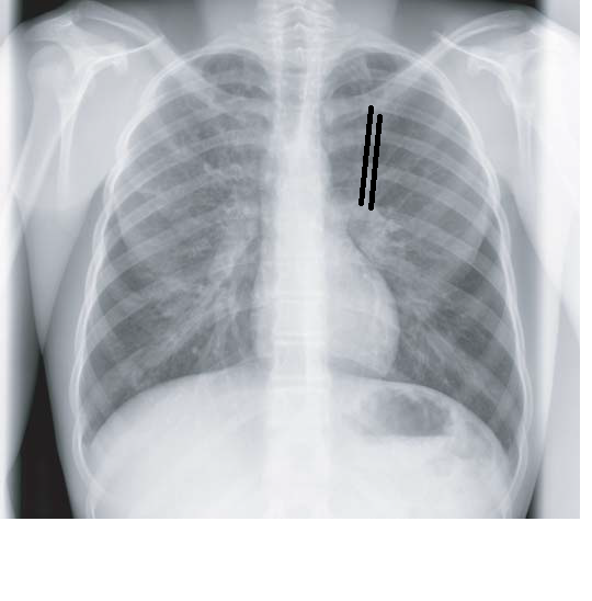 Chest Medicine Made EasyDr Deepu The Rings !!!The Trams!!!, Chest X