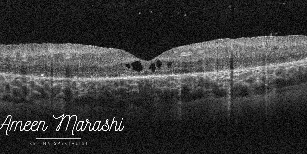 ConeRod Dystrophy complicated with cystoid macular edema