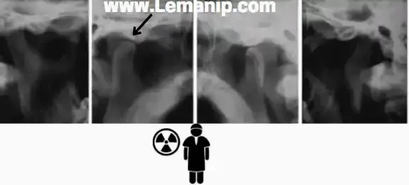 Radiologie des Articulations Temporo-Mandibulaire