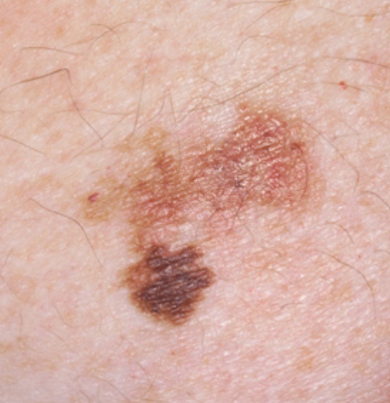 Picture of Basal Cell Carcinoma - WebMD