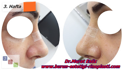 Before and the after the open technique rhinoplasty in İstanbul, Turkey - Rhinoplasty images - after rhinoplasty recovery - edema after rhinoplasty - rhinoplasty photos - Rhinoplasty Istanbul - Turkey Rhinoplasty - Rhinoplasty before and after images - Before and after photos for nose job in İstanbul - Photographs before and after the rhinoplasty operation in Turkey