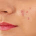 Learn why Pimples are on the face?