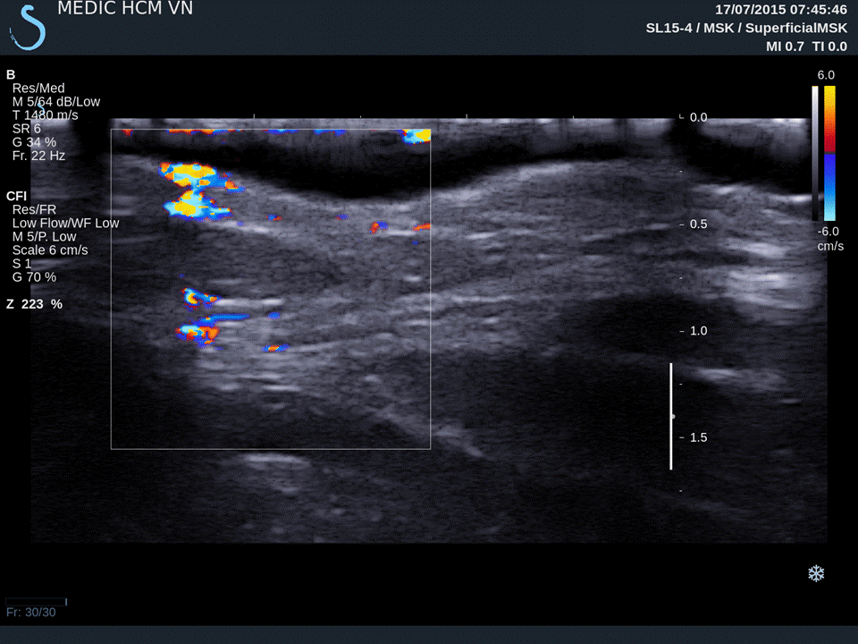 VIETNAMESE MEDIC ULTRASOUND CASE 325 STRETCH MARKS SKIN, Dr PHAN