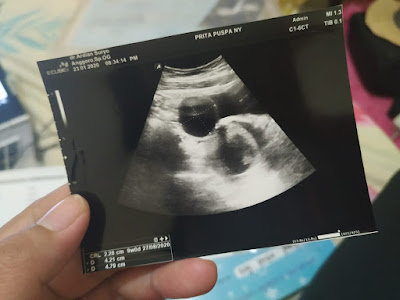 Blog Of Prita: Hamil dengan Kista Ovarium?