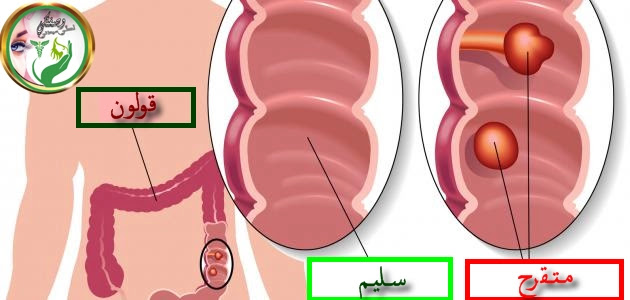 أعراض القولون التقرحي أعراض القولون التقرحي