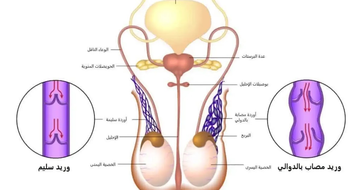 مرض دوالي الخصية