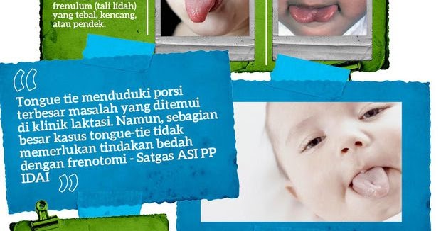 Gambar jenis tongue-tie pada bayi