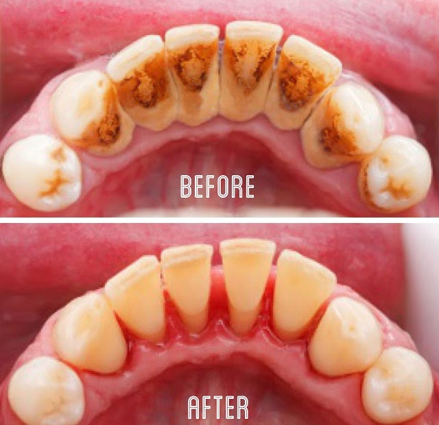 Dentin Enamel: Karang Gigi dan Cara Mencegahnya