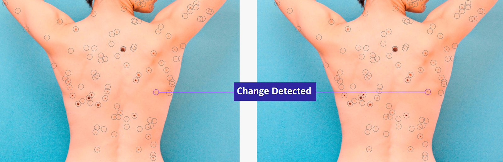 Mole Map Chevron Advanced Medical