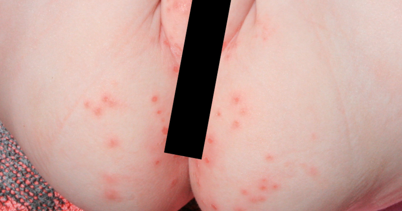 How to prevent and Treat Baby Rashes (Diaper Rash & Heat