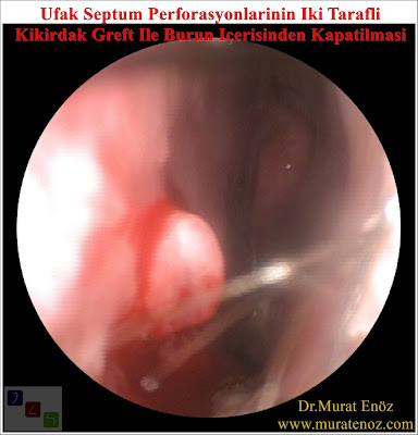 Nasal septum perforation - Septum perforation repair in Istanbul - Repairing of septum perforation - Patients with septum perforation - Doctors who is performing septum perforation repair in Istanbul - Hole on the nasal septum - Septum perforation surgery - Septum perforation - Septal perforation repair  in Istanbul - Small septum perforation repair - Intranasal repair of small septum perforation in Turkey