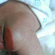 別人小孩紅屁股的治療經驗