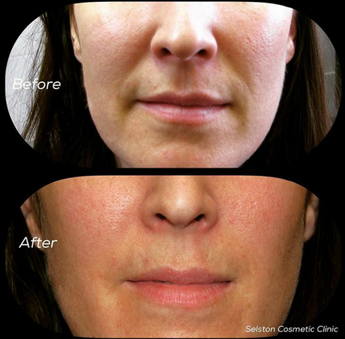 Selston Cosmetic Clinic Combat Facial Ageing With Dermal Fillers