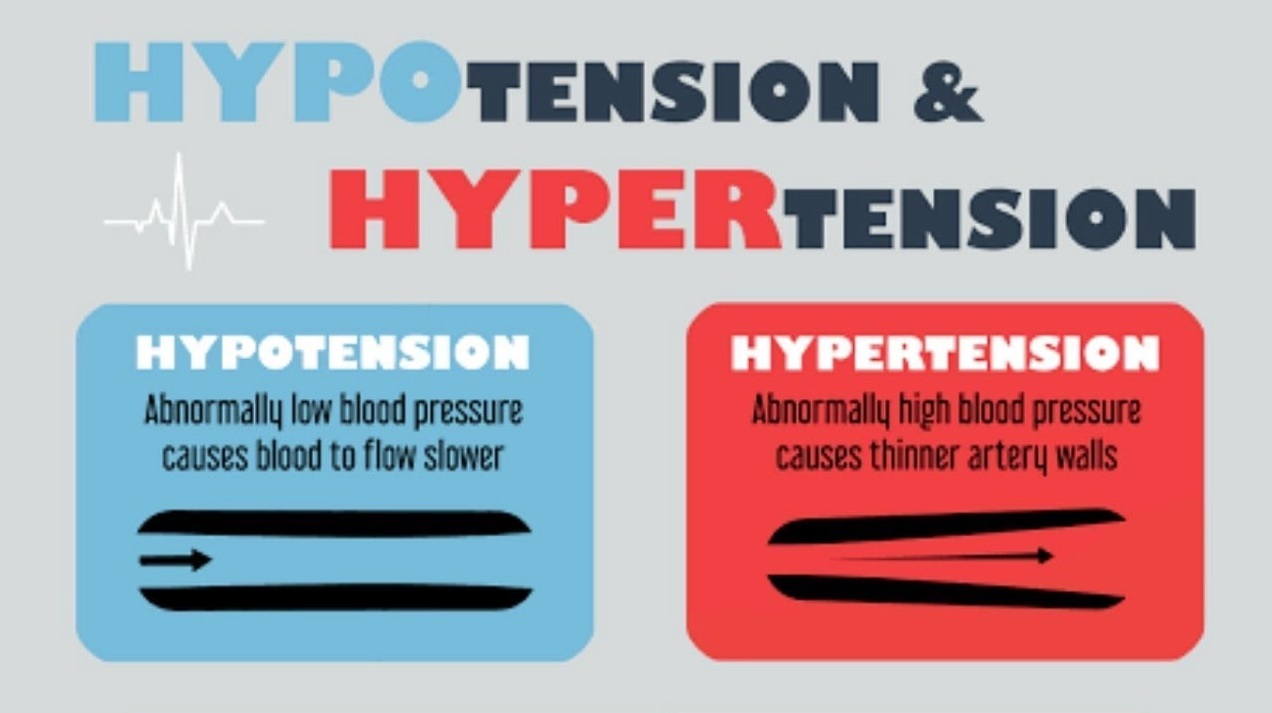 Hypertension Hypotension Cardiac output (2023)