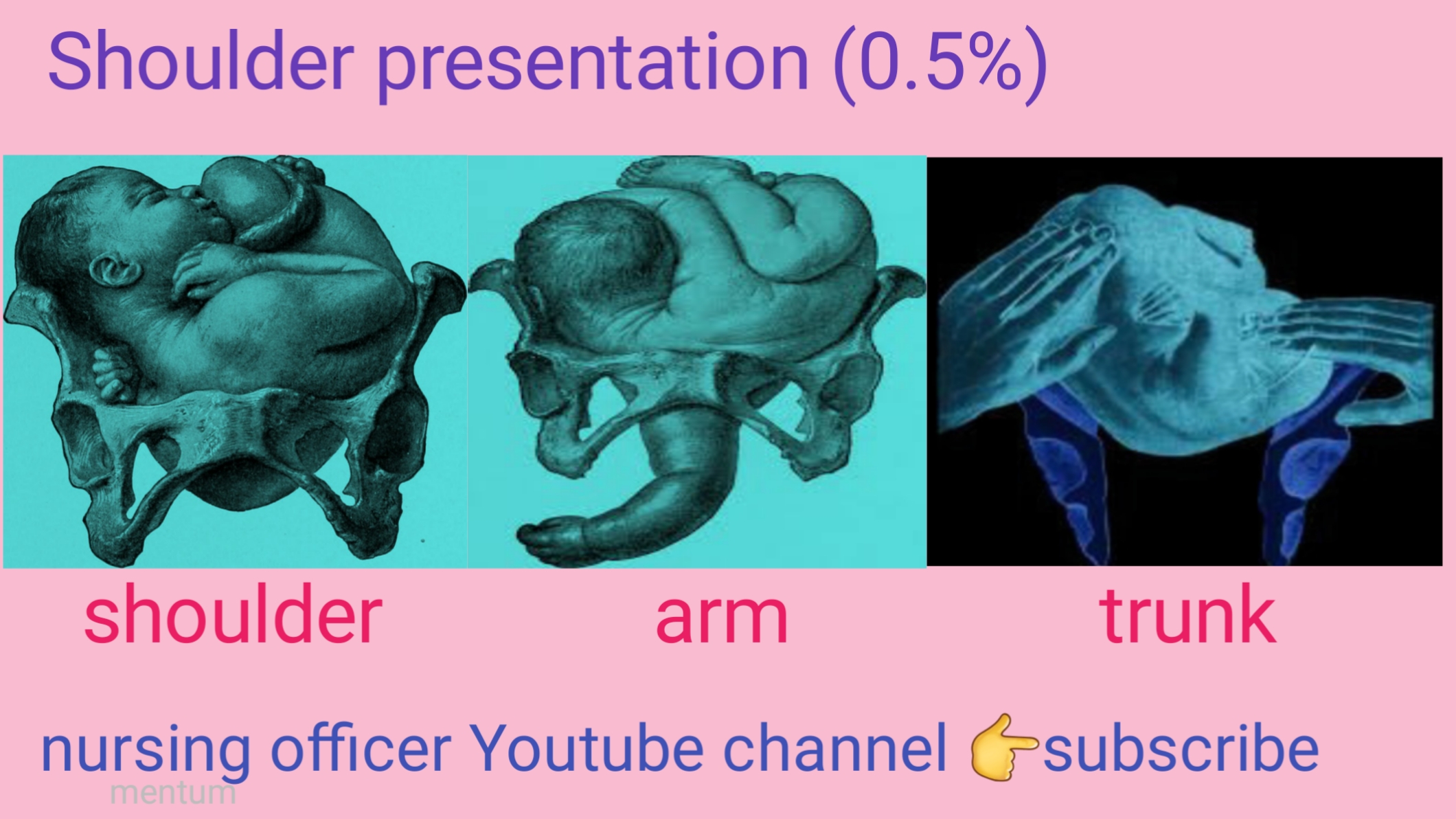compound presentation of fetus