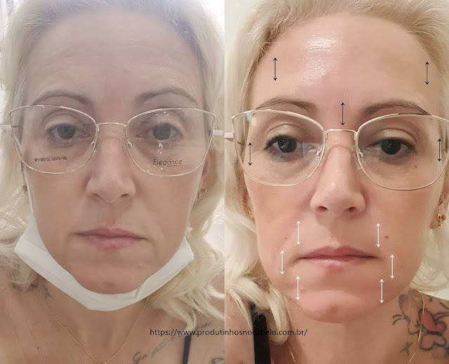 Botox e Preenchimento Facial 1ºDia