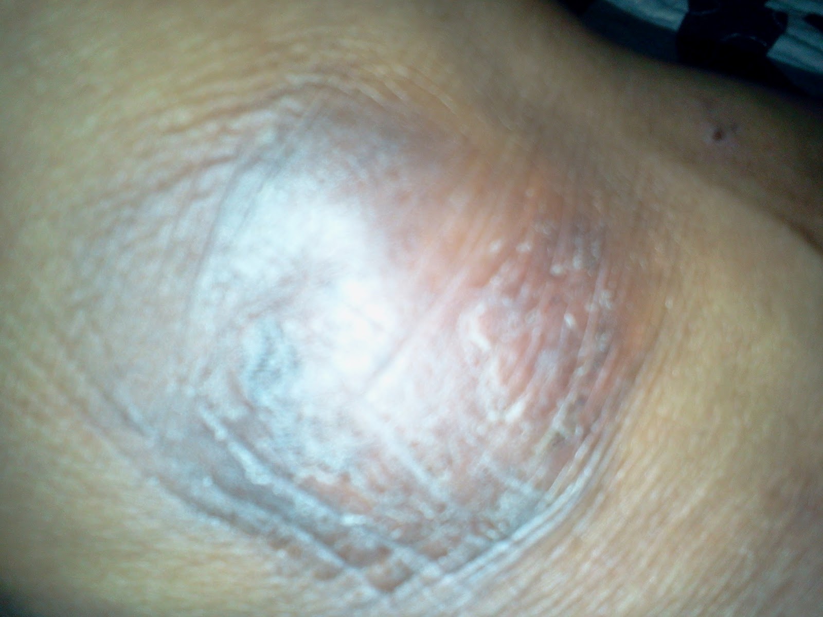 Psoriasis, Pemphigus Vulgaris &amp; Acoustic Neuroma Our