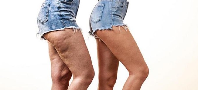 Κυτταρίτιδα: Τι είναι ο φλοιός πορτοκαλιού και πώς αντιμετωπίζεται