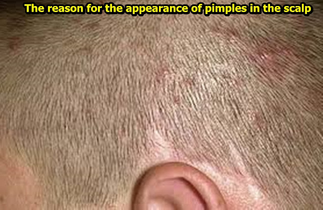The reason for the appearance of pimples in the scalp The reason for the appearance of pimples in the scalp