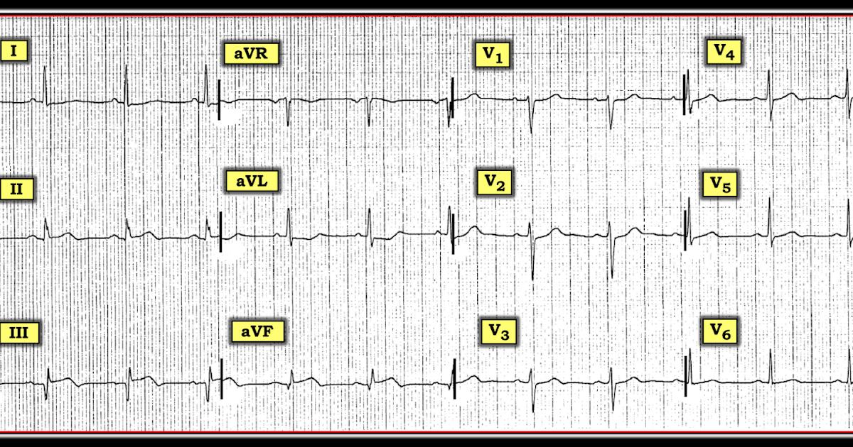 Интервал pr на экг. Экг avr avl avf. Avr отведение экг. Avr экг расшифровка. Avr отведение экг.