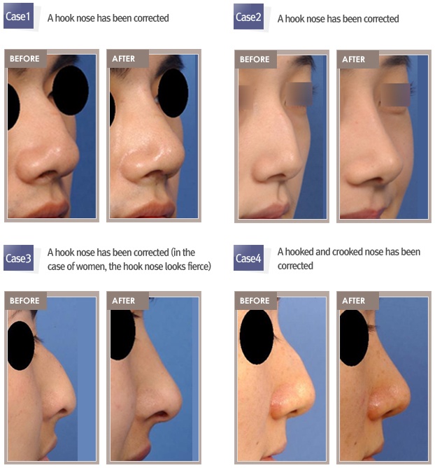 WIZmedi Korean Plastic Surgery Tourism Agency Hooked nose