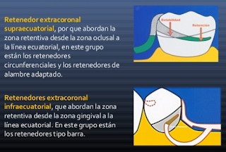 Prótesis Parcial Removible (PPR)