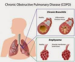Journal of COPD