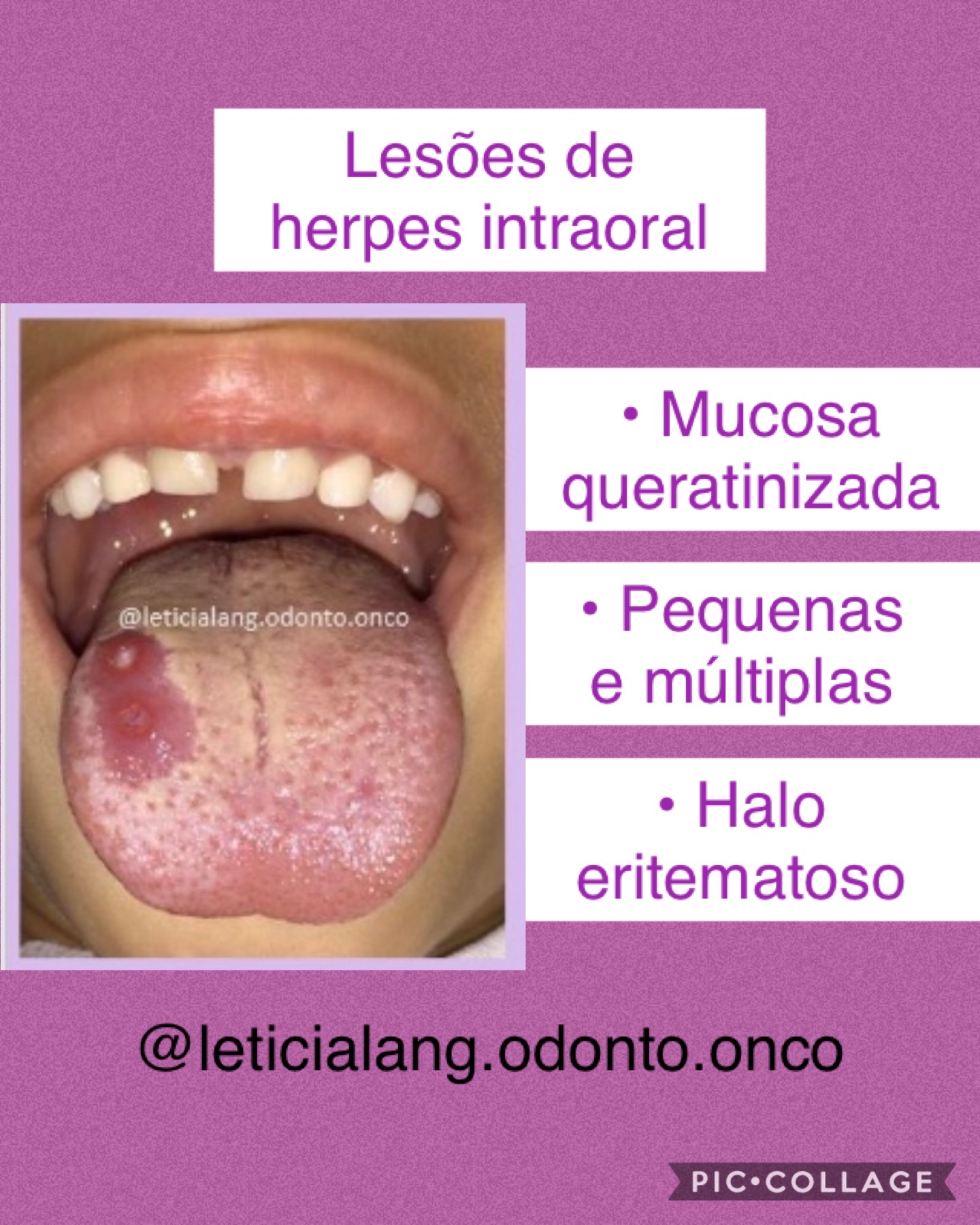 Letícia Lang Odontooncologia Herpes intraoral?